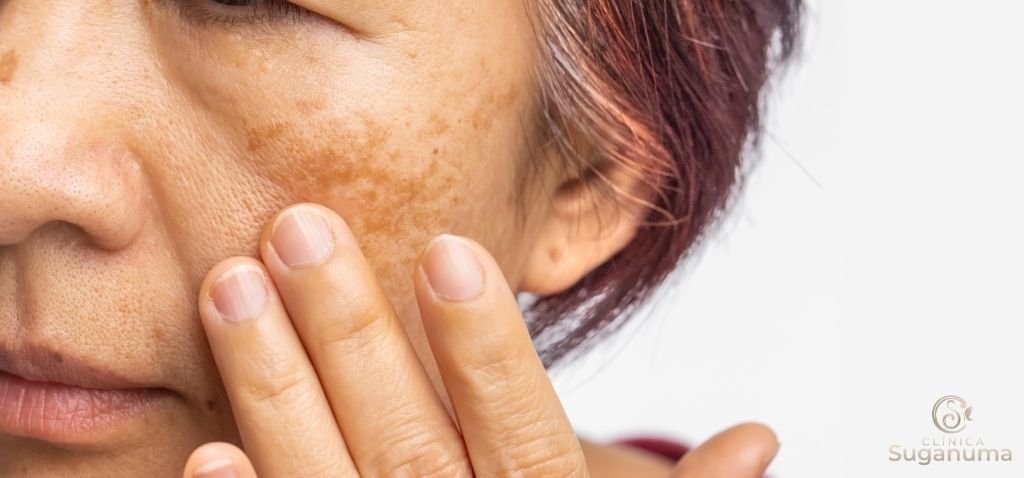 As-manchas-do-rosto-podem-ser-prevenidas-com-mudancas-na-rotina-de-cuidados-com-a-pele