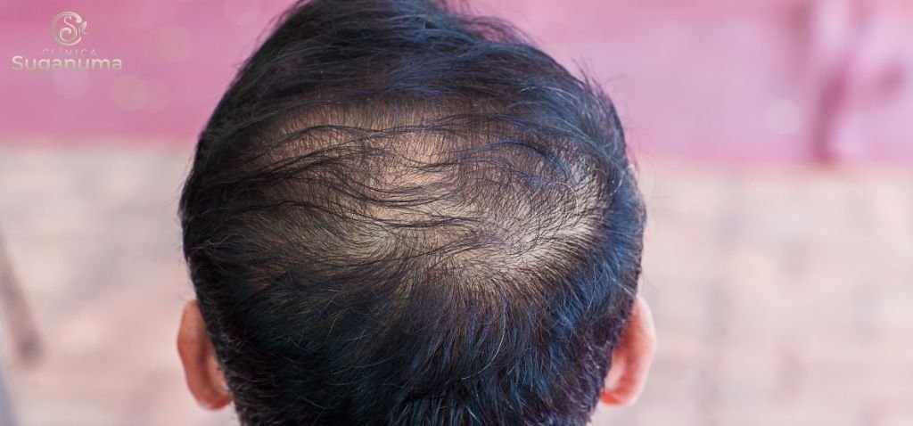 Como-tratar-a-queda-de-cabelo-de-forma-eficaz